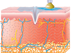 Image of Collagen Synthesis Begins