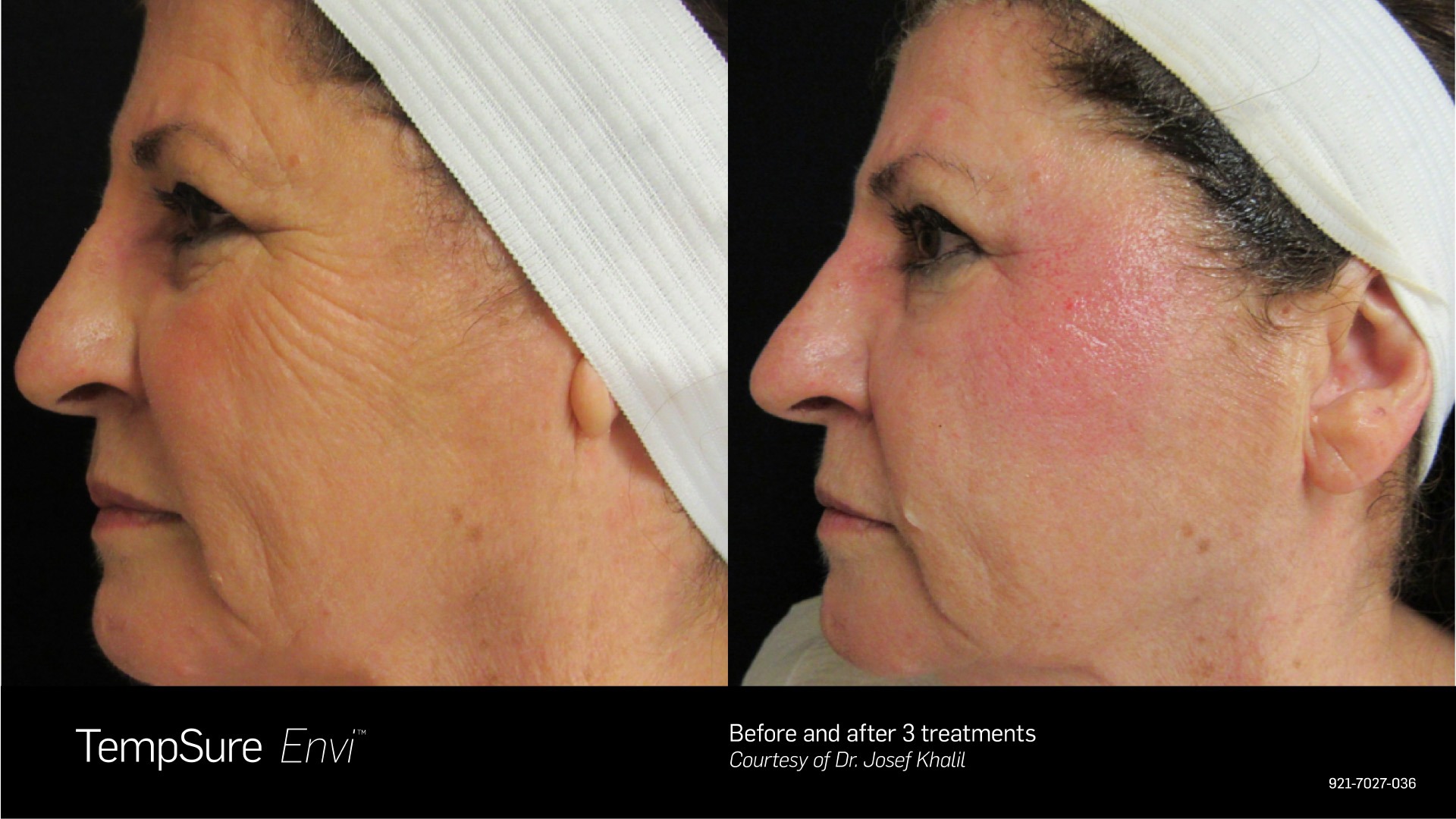 TempSure Before and After 3 Treatments