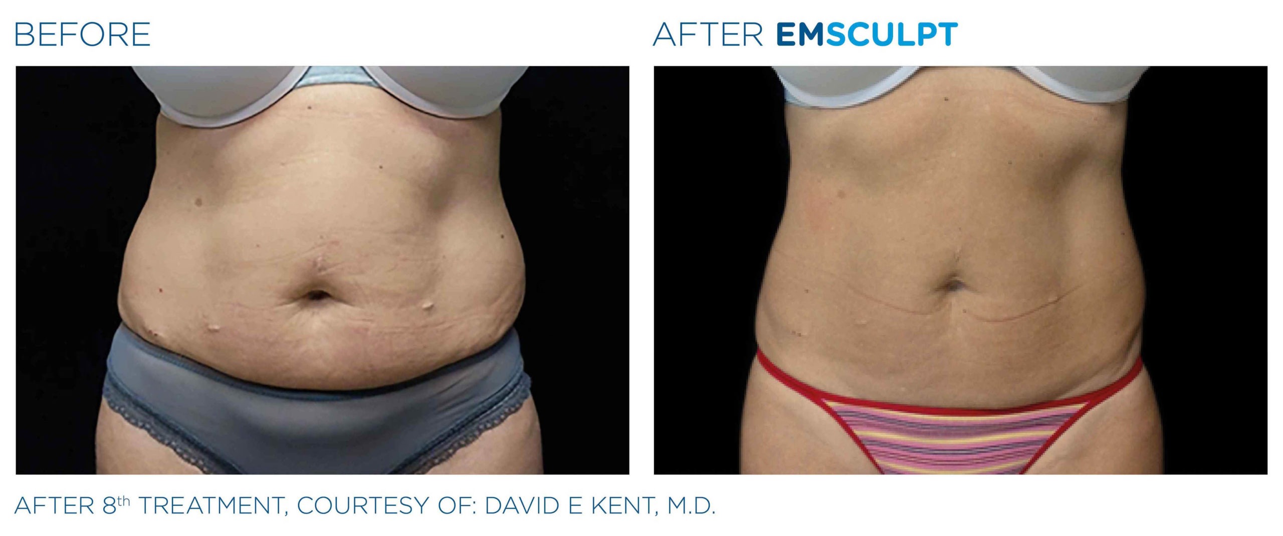 EMSCULPT Before and After