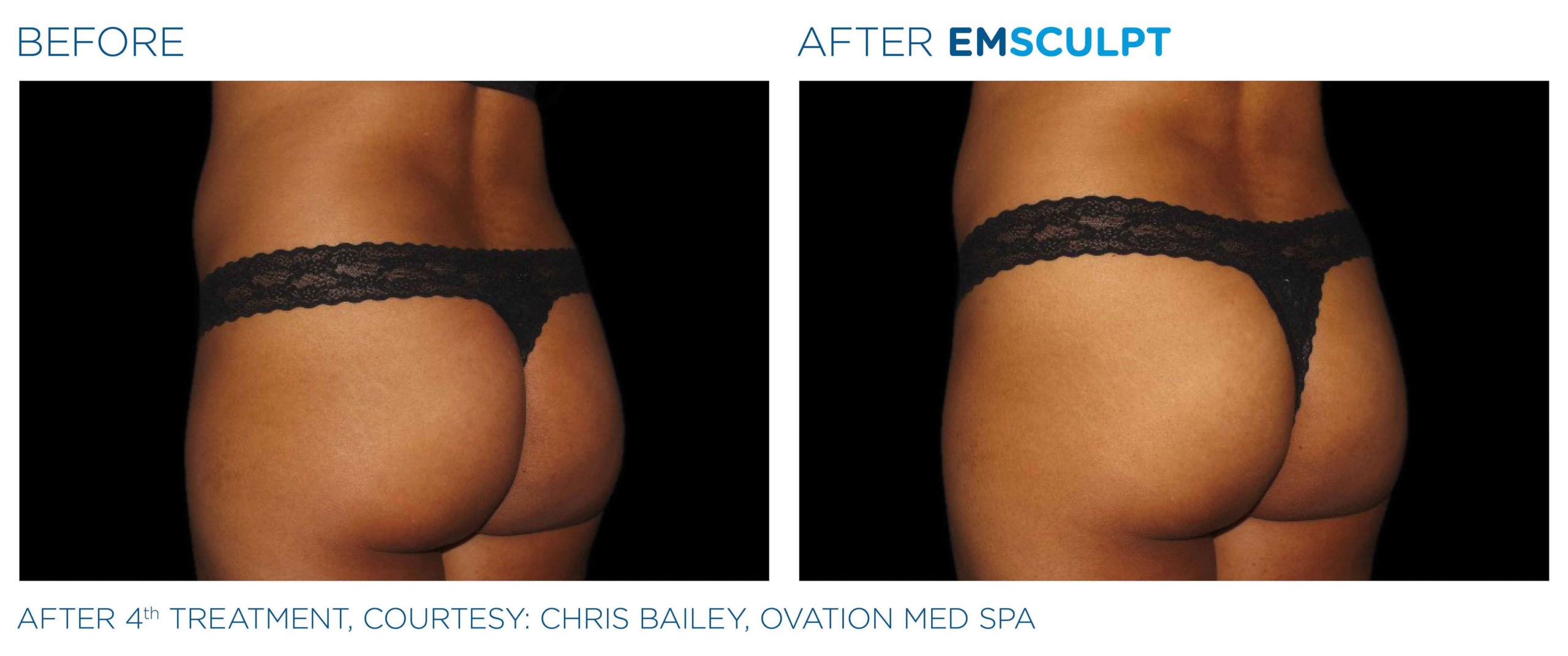 EMSCULPT Before and After