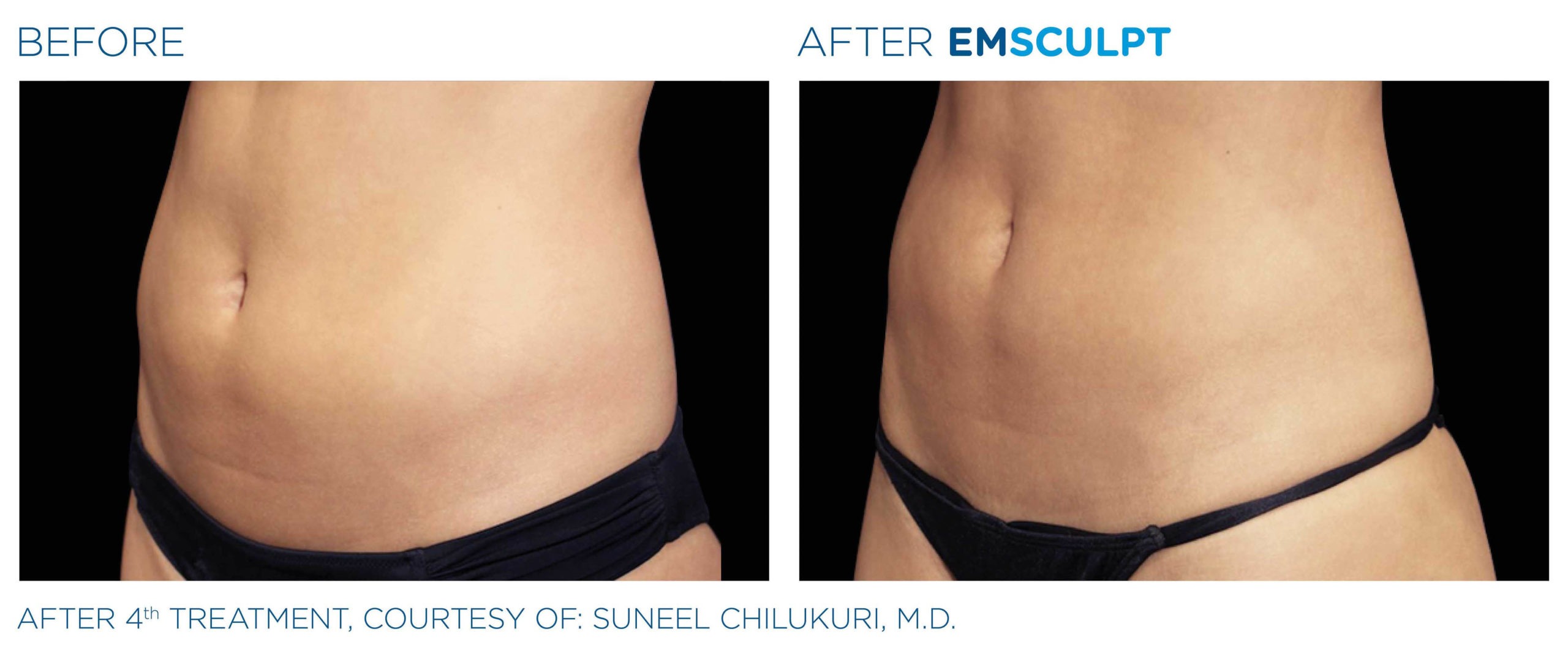 EMSCULPT Before and After