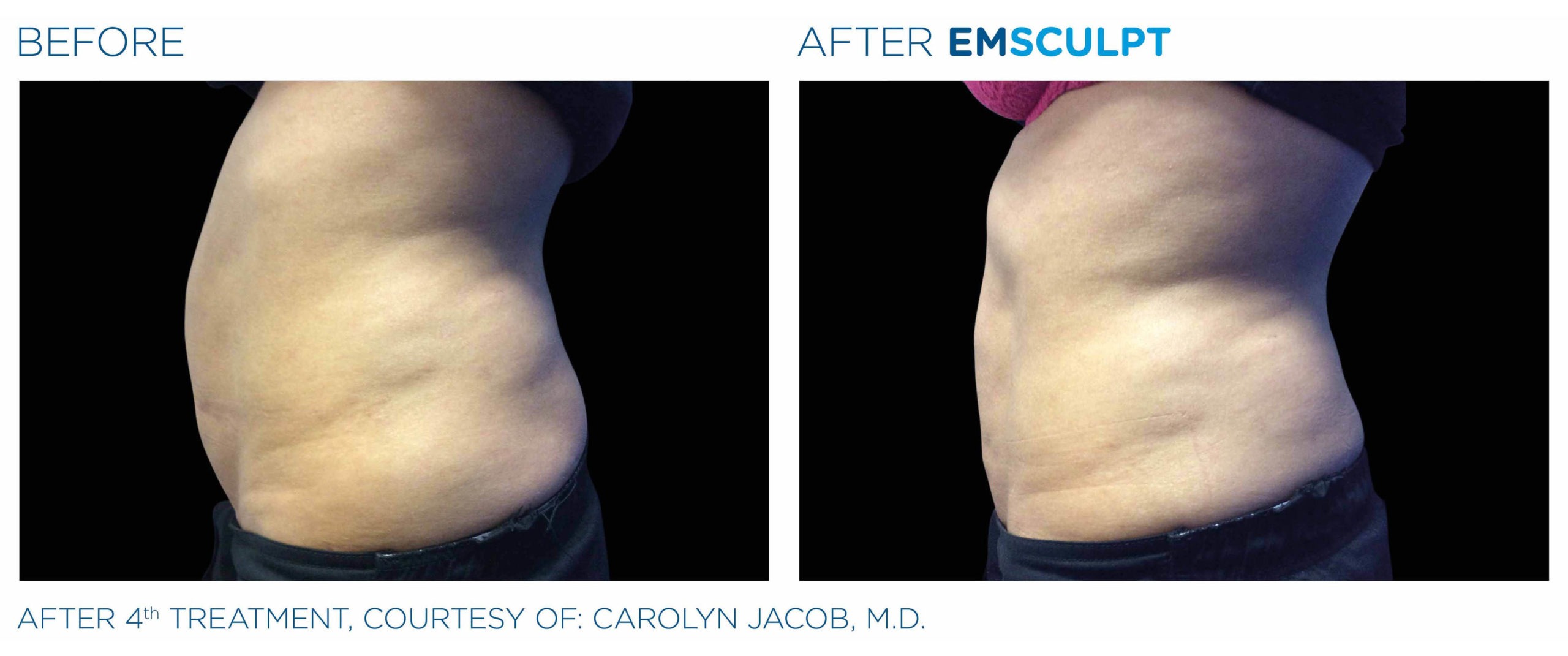 EMSCULPT Before and After