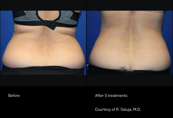 TempSure FlexSure Before and After