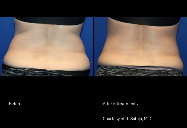 TempSure FlexSure Before and After