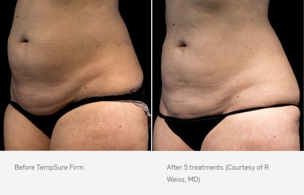 TempSure Firm Before and After