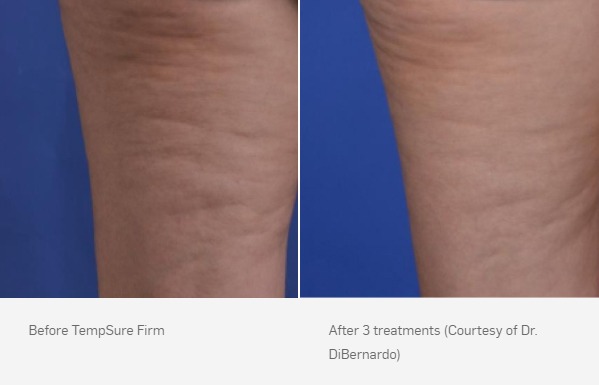 TempSure Firm Before and After