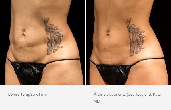 TempSure Firm Before and After