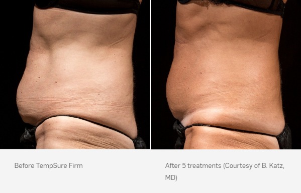 TempSure Firm Before and After