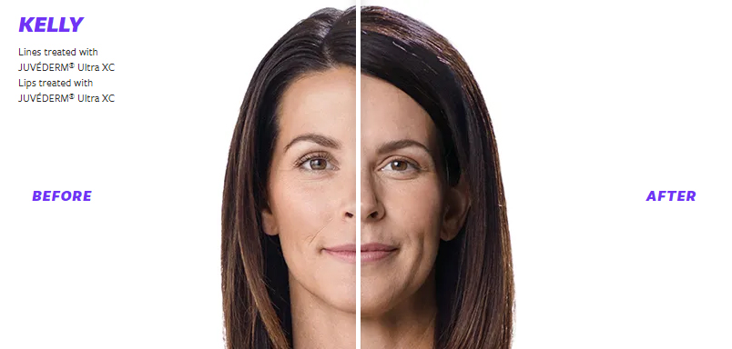 Juvederm Before & After 2